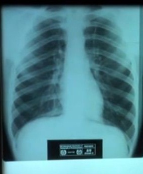 X-ray of healthy lungs