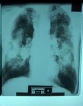 X-ray of silicosis lungs