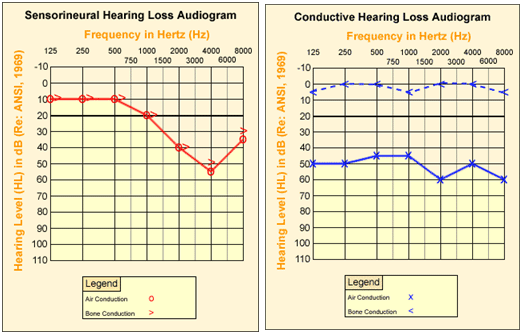 Audiograms - (Left diagram) Sensorineural Hearing Loss Audiogram includes Hearing Level (HL) in dB (Re: ANSI, 1969) and Frequency in Hertz (Hz) with values from left to right being 10 (HL)/125(Hz), 10(HL)/250(Hz), 10(HL)/500(Hz), 20(HL)/1000(Hz), 40(HL)/2000(Hz), 50(HL)/4000(Hz), between 30-40 (HL)/8000 (Hz), (Right diagram) Conductive Hearing Loss Audiogram includes Hearing Loss Audiogram includes Hearing Level (HL) in dB (Re: ANSI, 1969) and Frequency in Hertz (Hz) with two patterns, one sold line and one dotted line. For problems with accessibility in using figures, illustrations in this document, please contact the Directorate of Technical Support and Emergency Management at (202) 693-2300.
